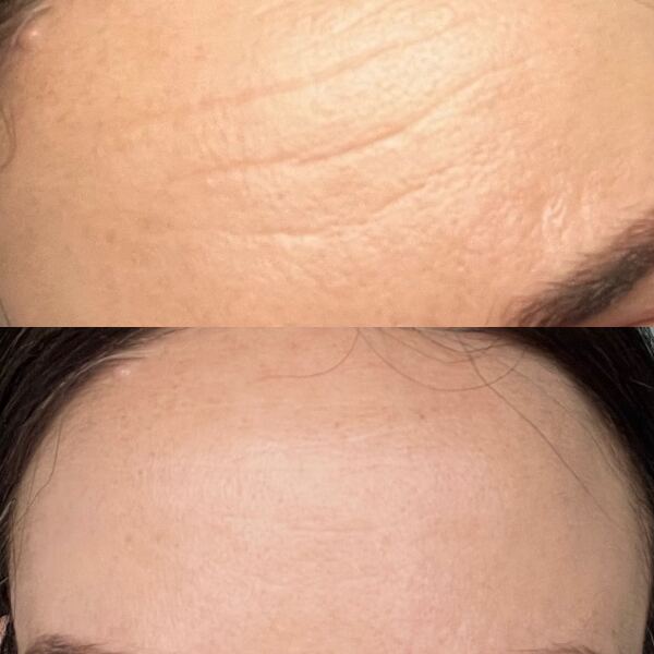 Experiences of baby Botox for early forehead lines and wrinkles