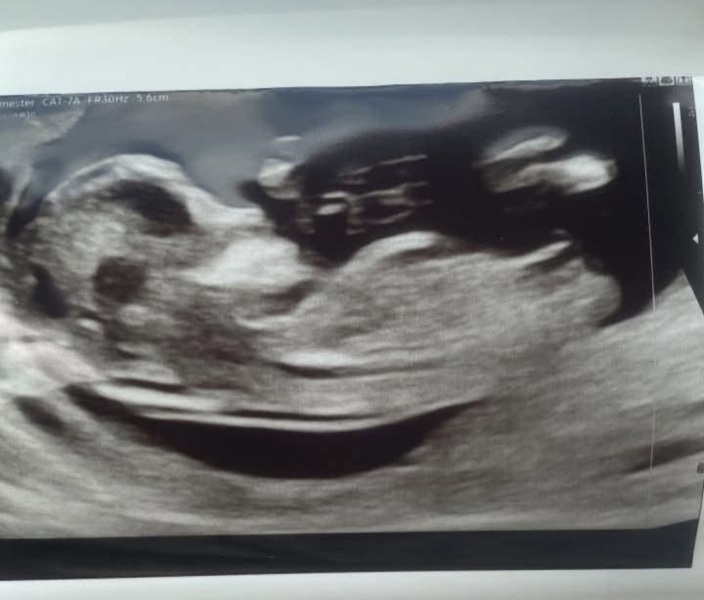 12 weeks and 5 days pregnant, any guesses on boy or girl?