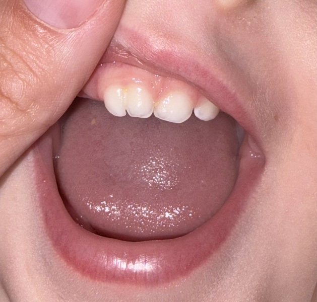 Has anyone’s child had a baby tooth like this before? - DD 18 months front tooth
