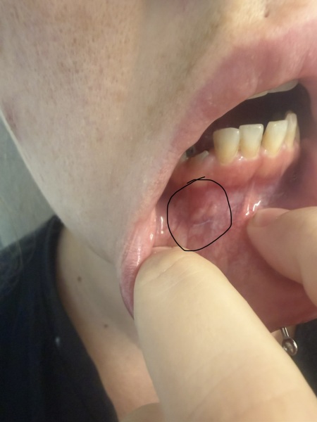 Lump on inside of mouth