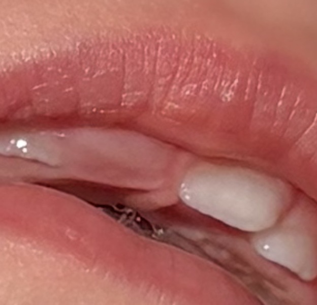 How long will 9 month olds tooth take to come through?