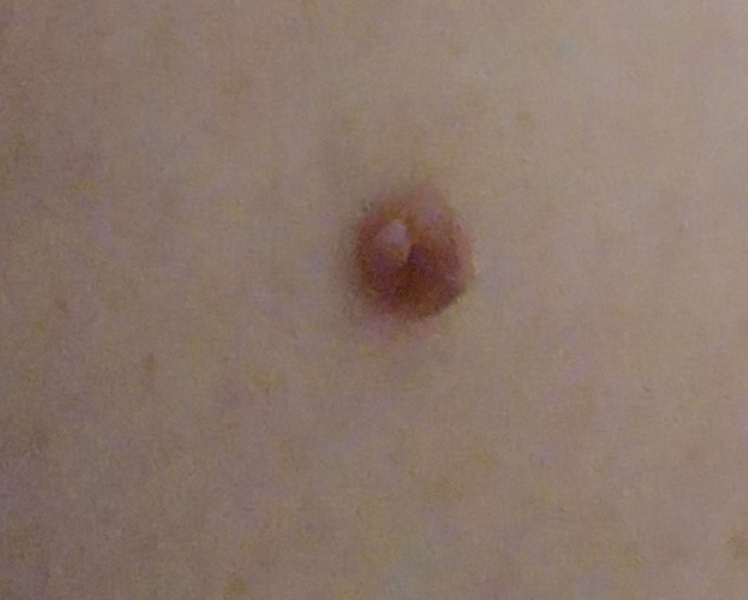 Mole 2ww