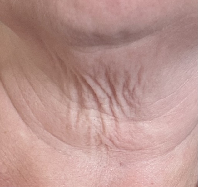 Turkey neck/chin :(