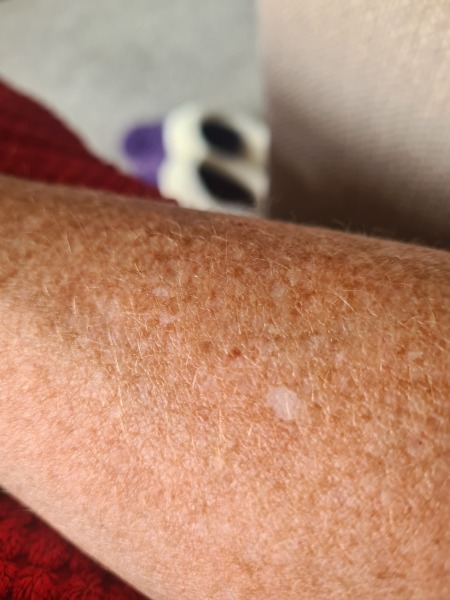 Does anyone know what these white marks on my arms are?