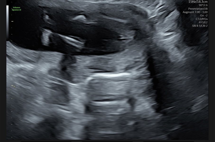 Do these 17-week scan photos suggest a girl to you too?