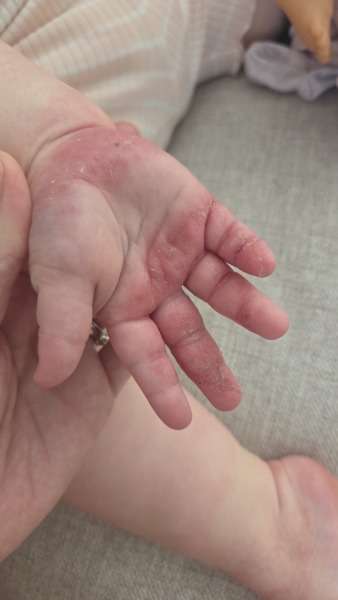 Two-year-old’s eczema improved abroad and flared again at home