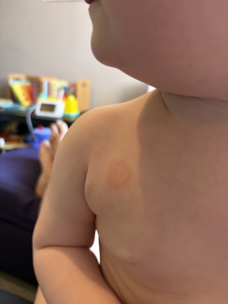 Has anyone's toddler had ringworm like this before?