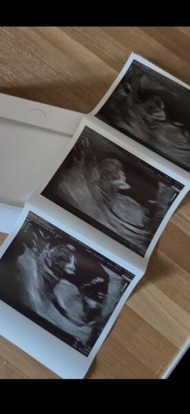 Any guesses on baby's sex from nub and skull theory scans?