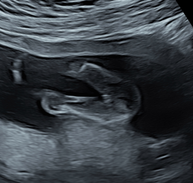 Sex of baby - girl or boy? Sonographer seemed unsure.