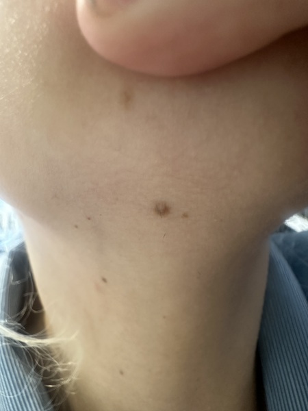Mole 2ww