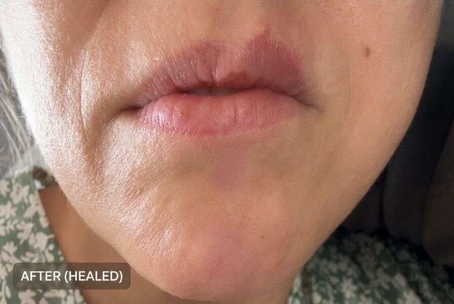 DD 17 mole with black hairs sprouting from it mole is fine can anything be done about the hair ?