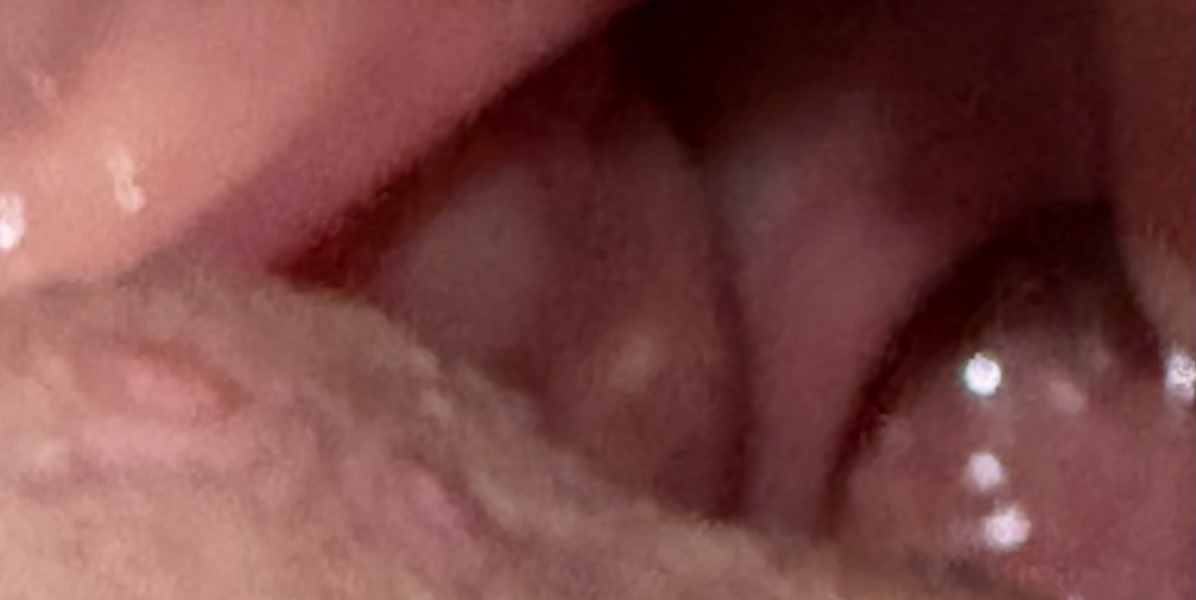 White spots on tonsils with sore throat, stones or infection?