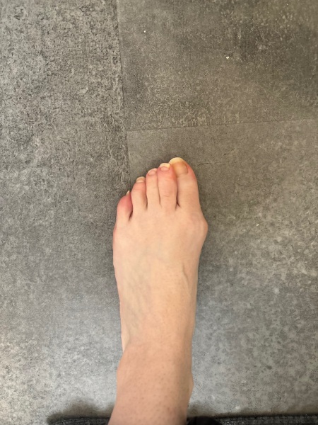 AIBU to ask my GP for help with painful bunion??