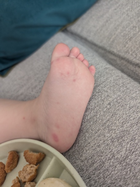 Rash after 18 month jabs or possible chickenpox, HFM or infection?