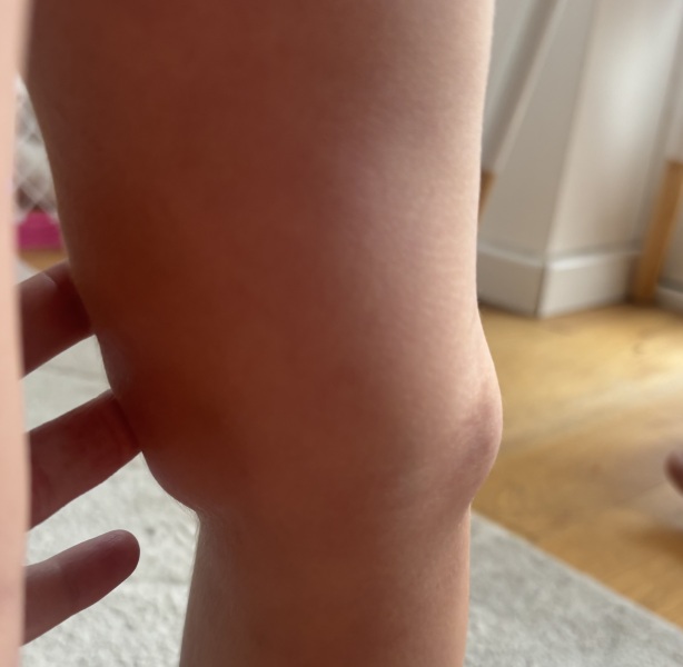 Suspected cancer behind child’s knee