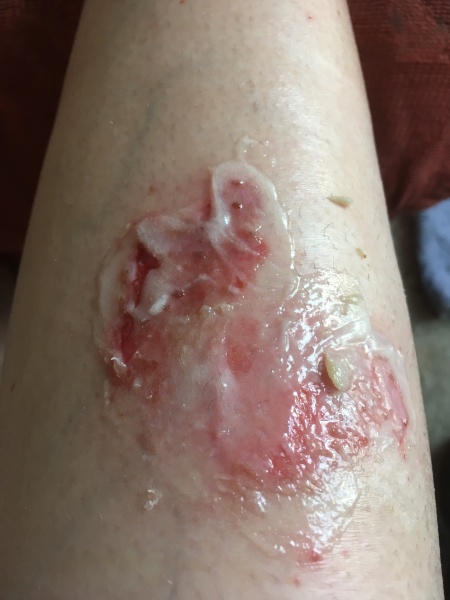 Has anyone had an insect bite go like this?