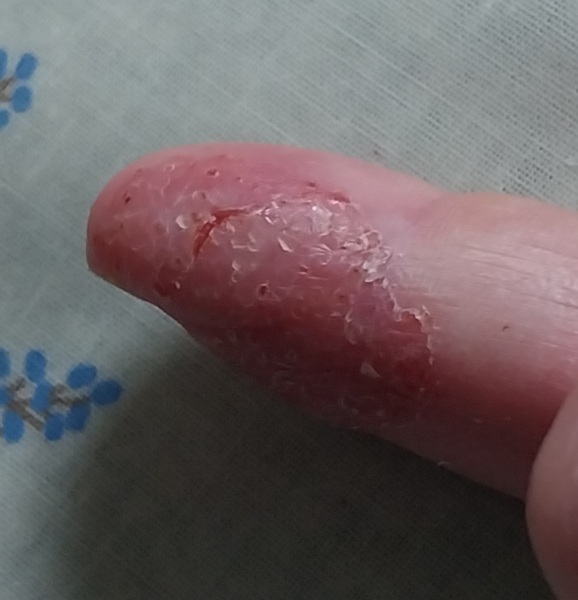 Is eczema always itchy? Cracked finger tips