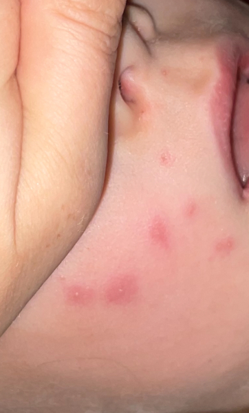 Fluid-filled spots on my six-year-old, any similar experiences?