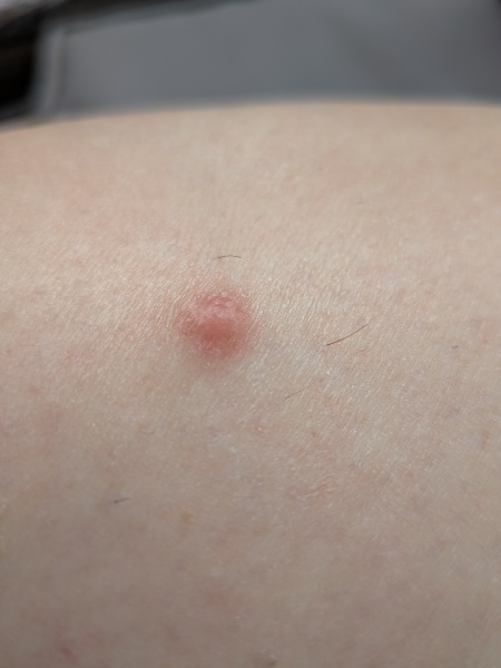 OK what is this on my leg and how can I get rid of it? (Includes pic)