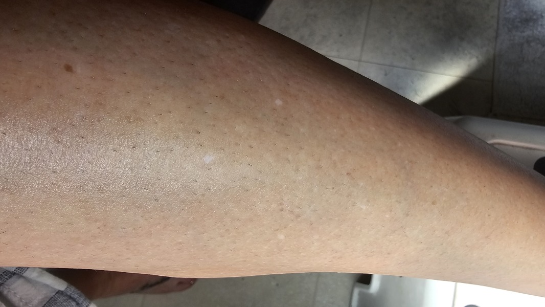 Does anyone know what these white marks on my arms are?
