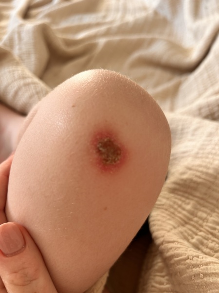 Does son’s scab look infected?