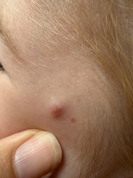 Toddler Skin bump