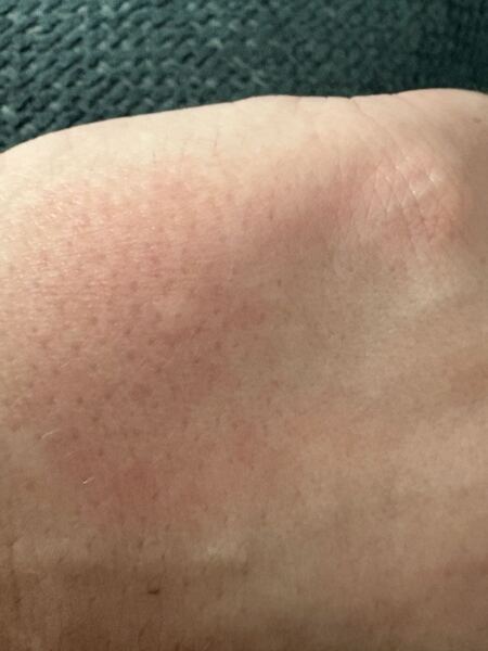 Itchy bumps on skin