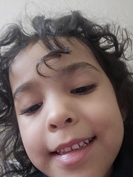 Dimple caused by cheek injury