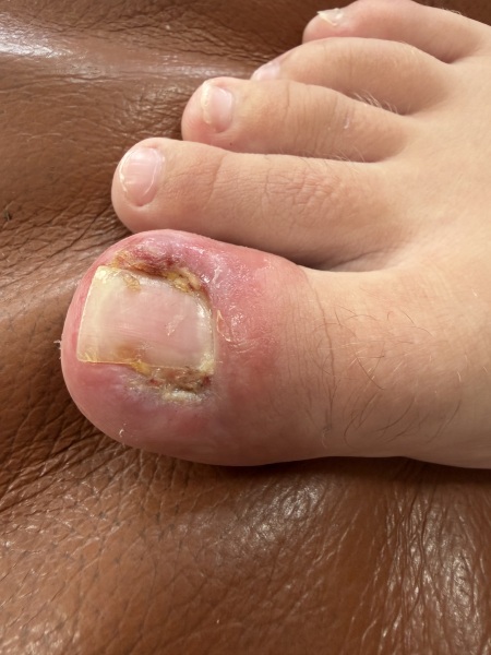 Partial toenail avulsion with phenol