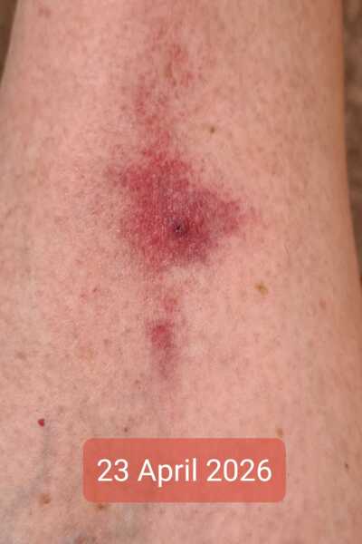 To think bug bites are particularly bad this year?