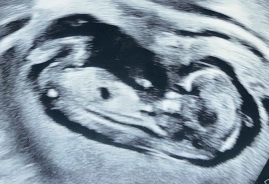 Private 13 week scan suggests boy, but can you really tell?