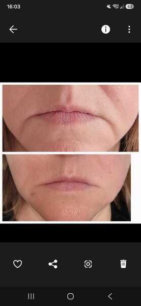 Botox/filler ladies PLEase help (pic inside)