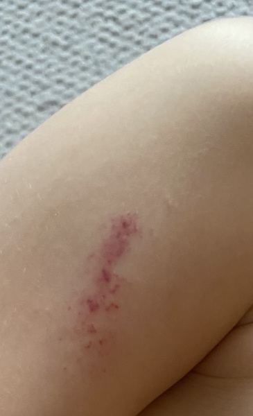 Strange mark on my four-year-old's arm, would you get it checked?