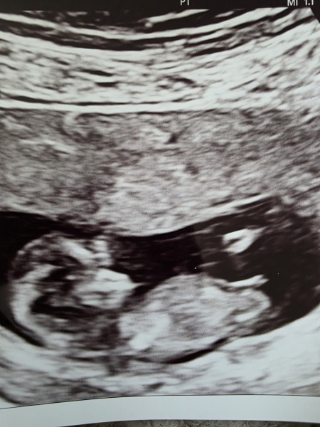 Nub theory. Boy or girl??