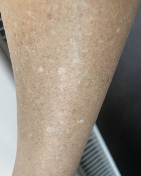 Does anyone know what these white marks on my arms are?