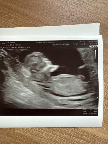 Any guesses on baby's sex from nub and skull theory scans?