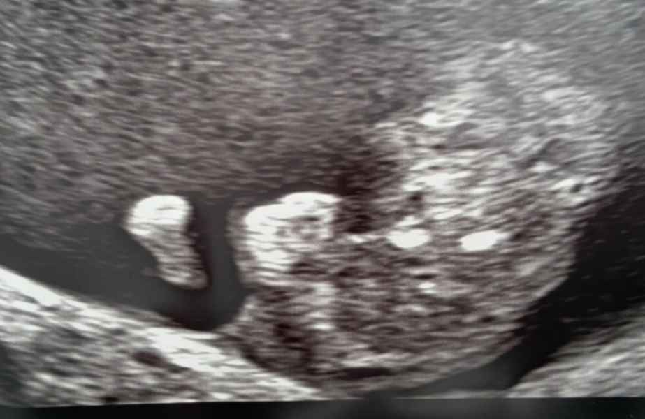 10 week scan ‘normal’ finding but I’m stressed