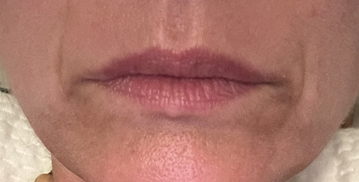 Botox/filler ladies PLEase help (pic inside)