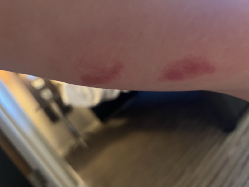 Insect bites TMI pics included