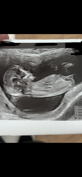 Can anyone help interpret my scan and nub theory guess?