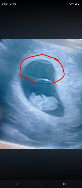 Twin pregnancy?