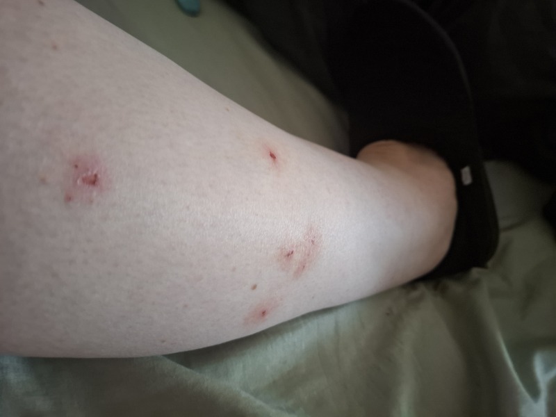 To think bug bites are particularly bad this year?