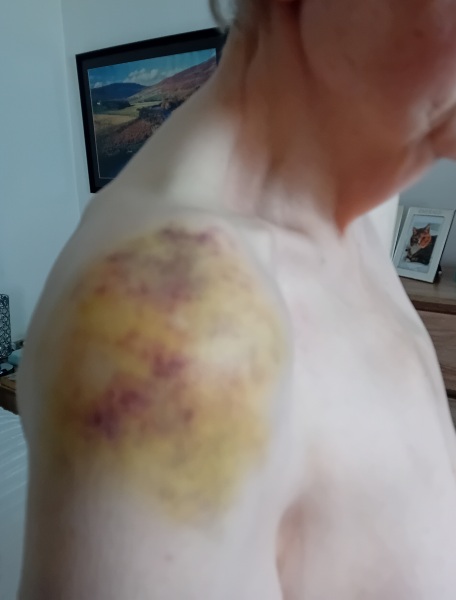 Mounjaro - 10 Stone or more to lose - Thread 14