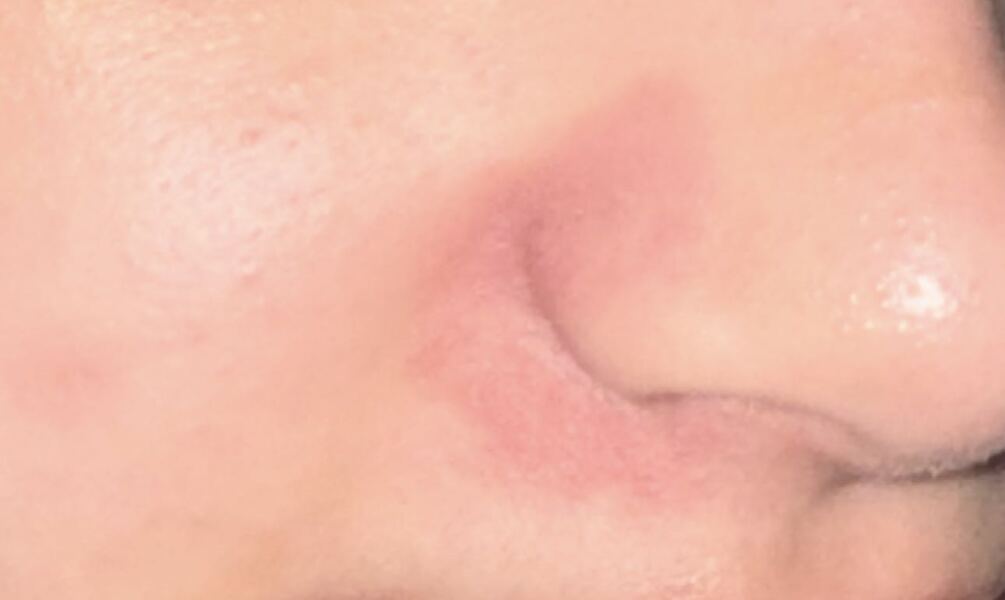 Teen daughter woke up with a rash on her face.