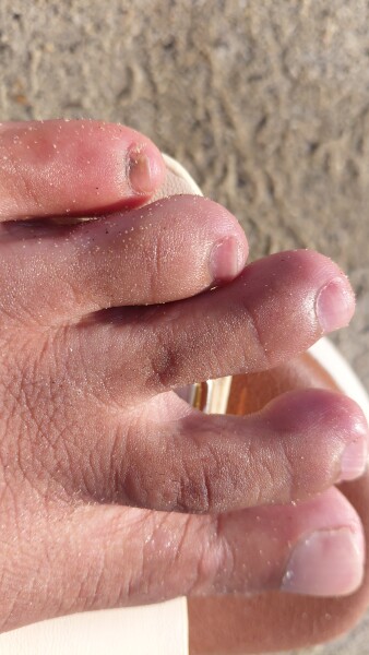 Sublungual melanoma fears - brown mark under toenail while on holiday and feeling anxious