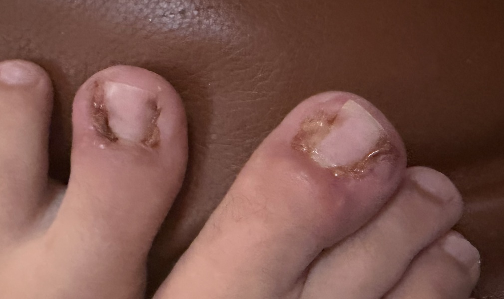 Partial toenail avulsion with phenol