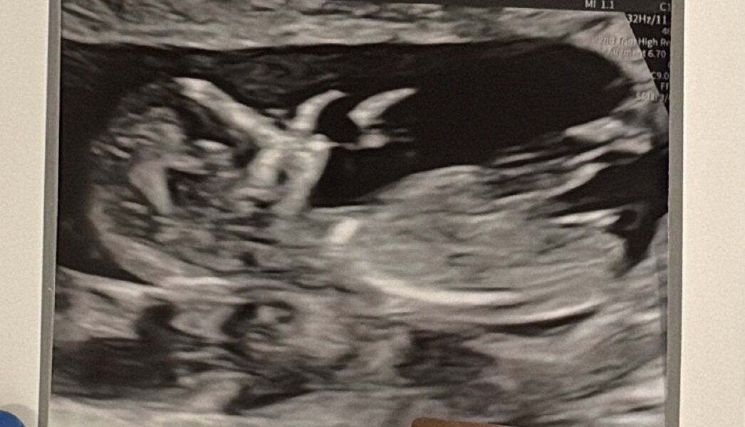 Nub theory? Boy or girl? 🩵🩷