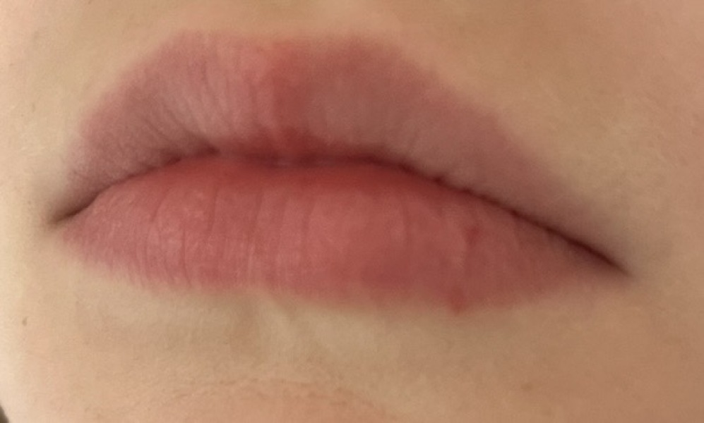 Is this a cold sore?