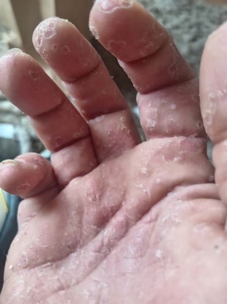 Is eczema always itchy? Cracked finger tips