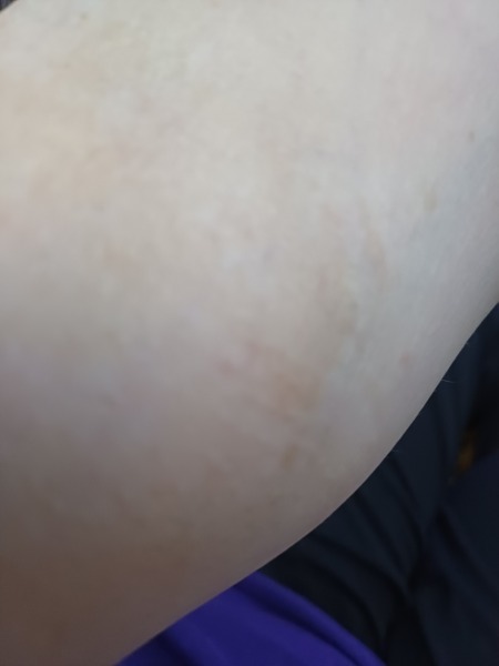 Ferritin 9 - iron infusion experiences?